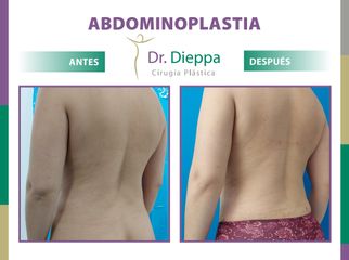 Abdominoplastia - Cirugía Plástica Dieppa
