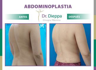 Abdominoplastia - Cirugía Plástica Dieppa