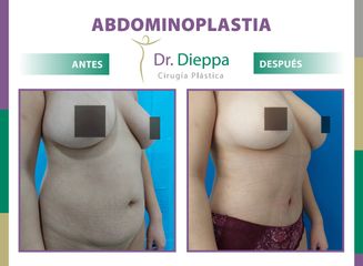 Abdominoplastia - Cirugía Plástica Dieppa