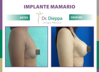 Aumento Mamario  - Cirugía Plástica Dieppa