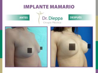 Aumento Mamario - Cirugía Plástica Dieppa