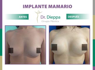 Aumento Mamario - Cirugía Plástica Dieppa