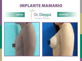 Aumento Mamario  - Cirugía Plástica Dieppa