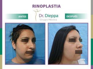 Rinoplastia - Cirugía Plástica Dieppa