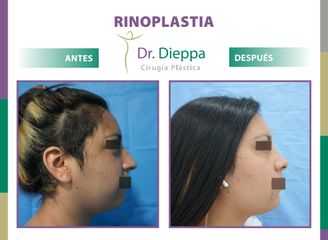 Rinoplastia  - Cirugía Plástica Dieppa