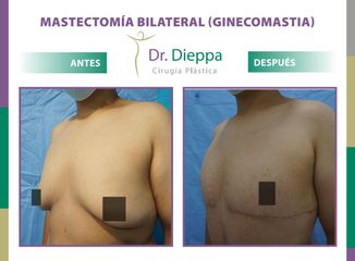 Mastectomía bilateral (Ginecomastia) Dr. Dieppa