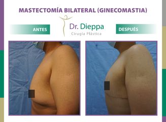 Mastectomía bilateral (Ginecomastia) Dr. Dieppa