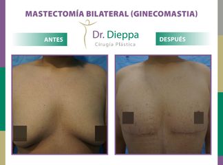 Mastectomía bilateral (Ginecomastia) Dr. Dieppa