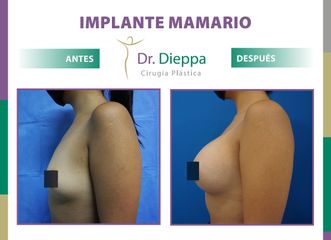 Aumento Mamario Dr Dieppa