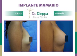 Aumento Mamario Dr Dieppa
