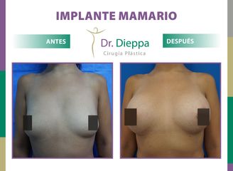 Aumento Mamario Dr Dieppa