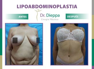 Lipo-abdominoplastia Dr. Dieppa