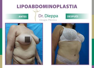 Lipo-abdominoplastia Dr. Dieppa