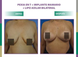 Pexia en T + implante mamario + lipo axilar bilateral Dr. Dieppa