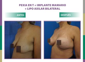 Pexia en T + implante mamario + lipo axilar bilateral Dr. Dieppa
