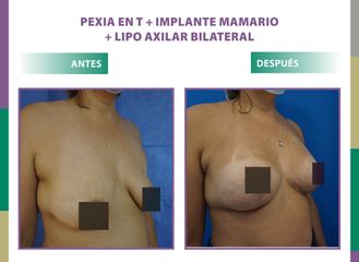 Pexia en T + implante mamario + lipo axilar bilateral Dr. Dieppa
