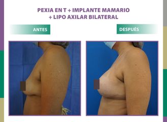 Pexia en T + implante mamario + lipo axilar bilateral Dr. Dieppa
