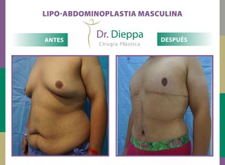 Abdominoplastia Masculina Dr. Dieppa