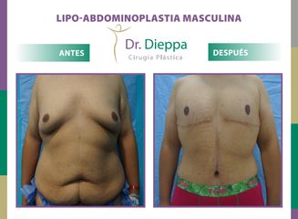 Abdominoplastia Masculina Dr. Dieppa