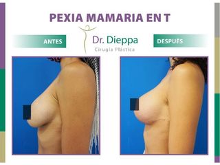 Mastopexia en T- Dr. Dieppa