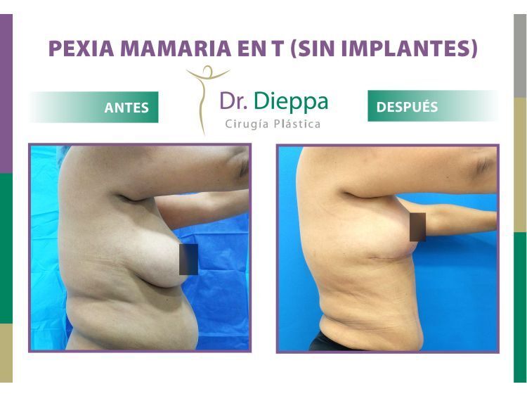 Mastopexia Antes Y Después Clinicasesteticas Cl Clinicasesteticas Cl