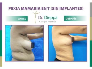 Mastopexia en T (Sin implantes) - Dr. Dieppa