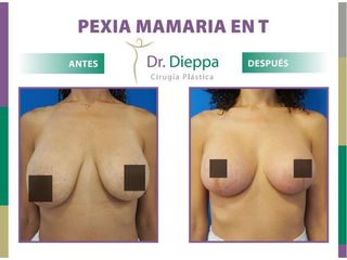Mastopexia en T - Dr. Dieppa