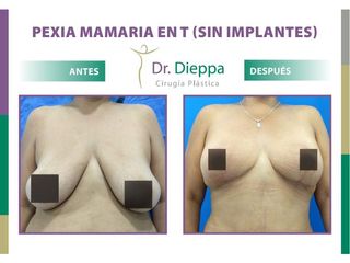 Mastopexia en T (Sin Implantes) - Dr. Dieppa