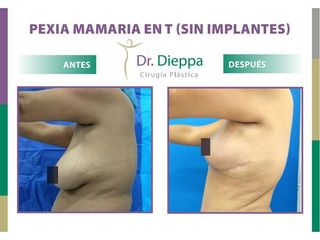 Mastopexia en T (Sin Implantes) - Dr. Dieppa