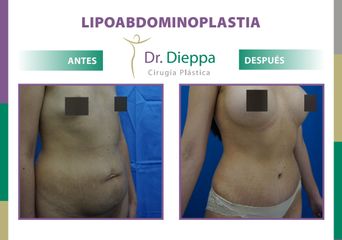 Lipo-abdominoplastia - Dr. Dieppa