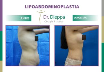 Lipo-abdominoplastia - Dr. Dieppa