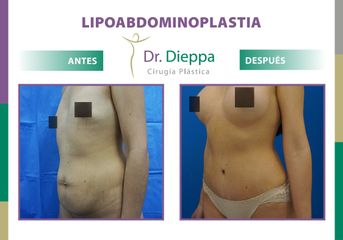 Lipo-abdominoplastia - Dr. Dieppa