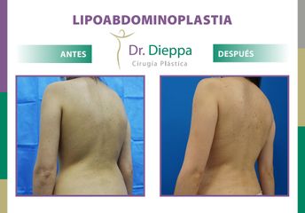 Lipo-abdominoplastia - Dr. Dieppa