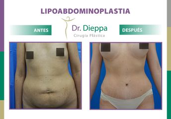 Lipo-abdominoplastia - Dr. Dieppa
