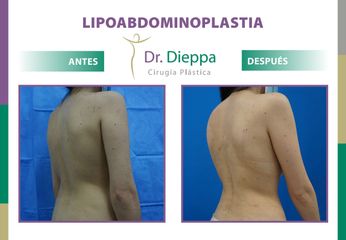 Lipo-abdominoplastia - Dr. Dieppa