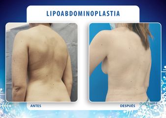 Lipo-abdominoplastia - Cirugía Plástica Dieppa