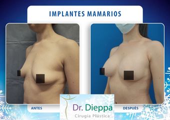 Implantes mamarios - Cirugía Plástica Dieppa