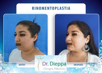 Rinomentoplastia - Cirugía Plástica Dieppa
