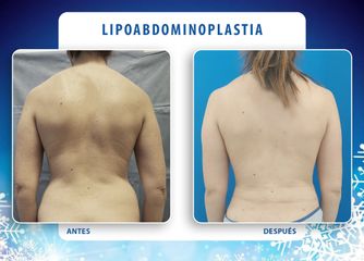 Lipo-abdominoplastia - Cirugía Plástica Dieppa