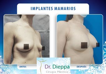 Implantes mamarios - Cirugía Plástica Dieppa