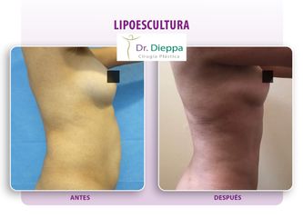 Lipoescultura - Cirugía Plástica Dieppa