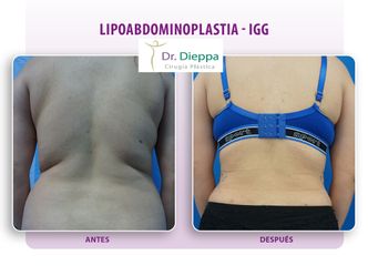 Lipo-abdominoplastia - Cirugía Plástica Dieppa