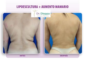 Lipo-abdominoplastia - Cirugía Plástica Dieppa