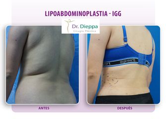 Lipo-abdominoplastia - Cirugía Plástica Dieppa