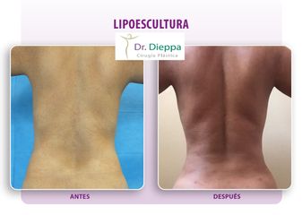 Lipoescultura - Cirugía Plástica Dieppa