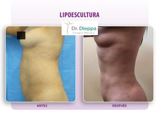 Lipoescultura - Cirugía Plástica Dieppa