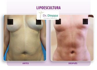 Lipoescultura - Cirugía Plástica Dieppa