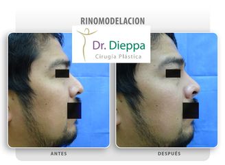 Rinomodelación - Cirugía Plástica Dieppa