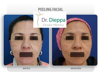Peeling Facial - Cirugía Plástica Dieppa