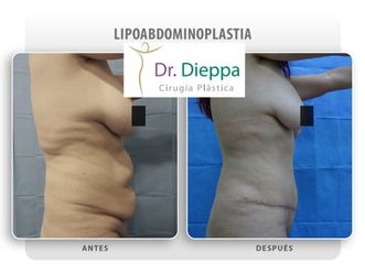 Abdominoplastia - Cirugía Plástica Dieppa